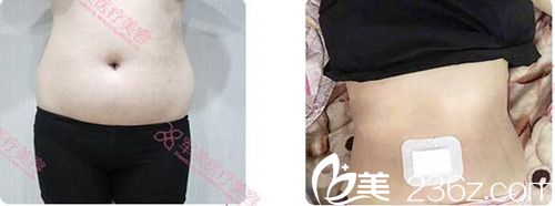 广州军美王世虎腰腹部环吸案例效果对比