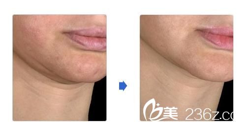 城野医生医疗美容医院Ulthera 照射治疗 城野医生医疗美容医院Ulthera 照射治疗