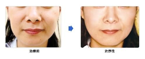 城野医生医疗美容医院热玛吉紧肤除皱 城野医生医疗美容医院热玛吉紧肤除皱