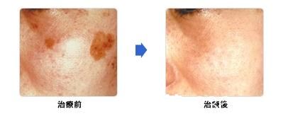 城野医生医疗美容医院激光祛斑 城野医生医疗美容医院激光祛斑