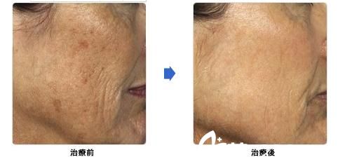 城野亲德激光除皱 城野亲德激光除皱