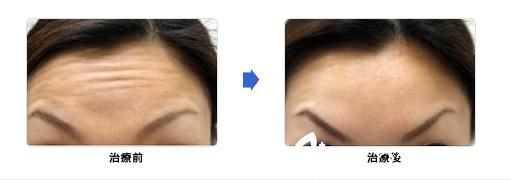 城野亲德瘦脸除皱注射 城野亲德瘦脸除皱注射