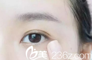 祛眼袋的作用