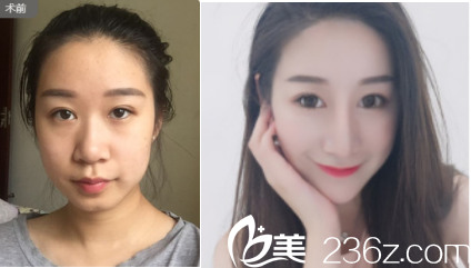 李德庆鼻综合案例