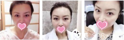 上海凯瑞医疗美容门诊部卫连坤面部埋线提升真人案例术后二十天