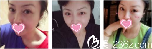 四十岁的阿姨在上海凯瑞找卫连坤做了面部埋线提升，才一个月的时间至少年轻六七岁