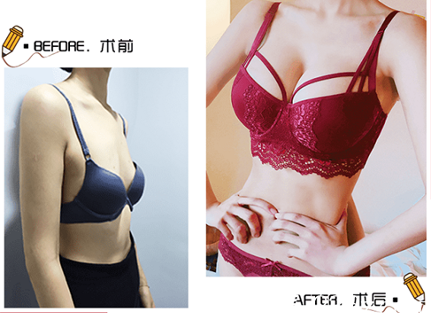 北京玲珑梵宫假体隆胸多少钱？WNS双平面动感假体隆胸价格及范元涛案例来参考