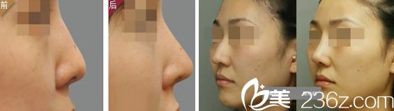 武汉中翰整形<!--<i data=20240703-sp></i>-->隆鼻案例 武汉中翰整形<!--<i data=20240703-sp></i>-->隆鼻案例