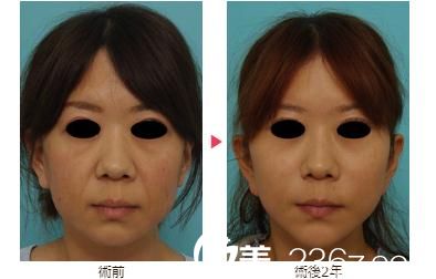 八事石坂美容外科医院面部拉皮 八事石坂美容外科医院面部拉皮