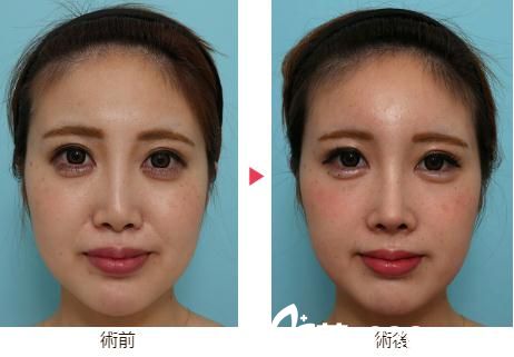 八事石坂美容外科医院综合隆鼻 八事石坂美容外科医院综合隆鼻