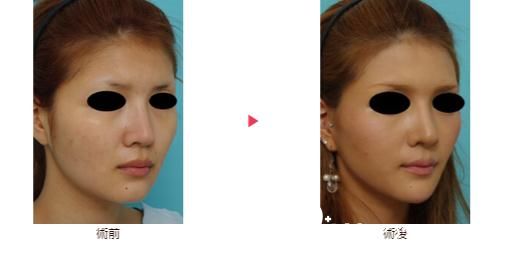 大口春雄面部拉皮 大口春雄面部拉皮