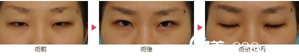 大口春雄双眼皮手术 大口春雄双眼皮手术