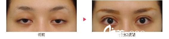 大口春雄眼睑下垂修正