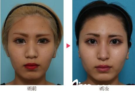 大口春雄综合隆鼻术