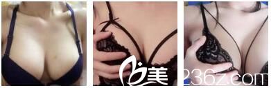 恢复过程中的自体脂肪丰胸术 恢复过程中的自体脂肪丰胸术