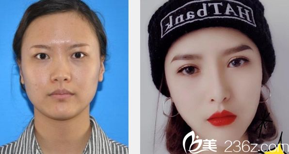 兰州亚韩谢雯急速纳米双眼皮+耳软骨综合隆鼻效果图 兰州亚韩谢雯急速纳米双眼皮+耳软骨综合隆鼻效果图