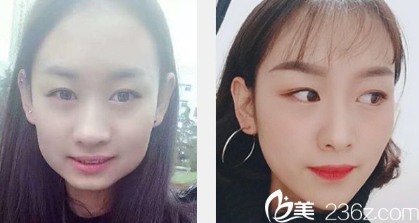 兰州亚韩赵贵庆下颌角整形前后效果对比照片 兰州亚韩赵贵庆下颌角整形前后效果对比照片