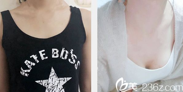 兰州亚韩雷蓓医生曼托假体隆胸效果案例 兰州亚韩雷蓓医生曼托假体隆胸效果案例