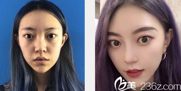 兰州亚韩玻尿酸去除法令纹效果 兰州亚韩玻尿酸去除法令纹效果