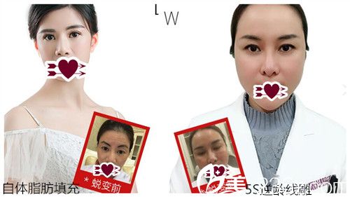 汕头曙光整形医院自体脂肪填充及线雕逆龄案例效果 汕头曙光整形医院自体脂肪填充及线雕逆龄案例效果