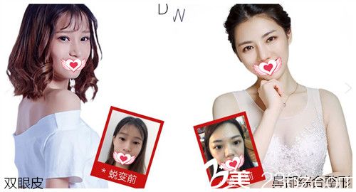汕头曙光整形双眼皮及隆鼻案例效果对比 汕头曙光整形双眼皮及隆鼻案例效果对比