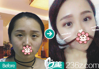 成都西区医院整形科双眼皮效果