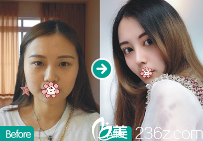 成都西区医院整形隆鼻术后效果