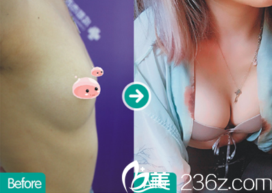 成都西区医院整形科自体脂肪丰胸