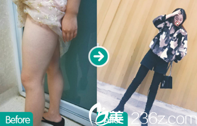 成都西区医院大腿吸脂术后效果对比