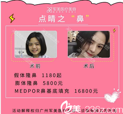 广州军美王世虎隆鼻案例价格表 广州军美王世虎隆鼻案例价格表