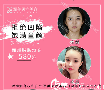 广州军美王世虎脂肪填充案例和价格单 广州军美王世虎脂肪填充案例和价格单