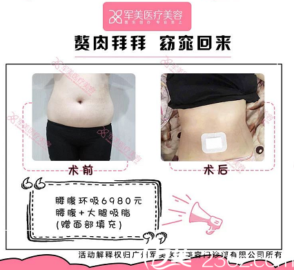 广州军美王世虎吸脂案例价格表 广州军美王世虎吸脂案例价格表