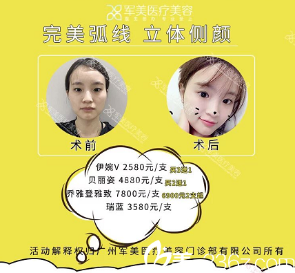 广州军美玻尿酸填充案例和优惠价格 广州军美玻尿酸填充案例和优惠价格