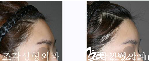 额头整形<span style= 额头整形<span style=