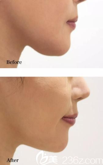 院长渡边裕之 下巴削骨 院长渡边裕之 下巴削骨