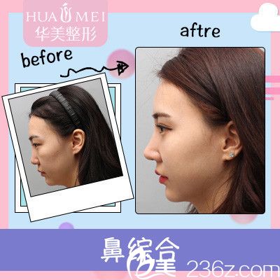 汕头华美张福奎做的双眼皮隆鼻案例