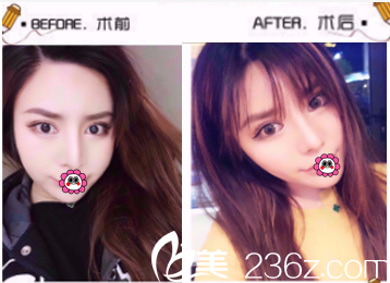 北京玲珑梵宫面部吸脂特惠价及案例抢先看！还有王光辉黄海滨医生坐诊