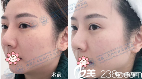 冯永强BBL美肤治疗案例 冯永强BBL美肤治疗案例