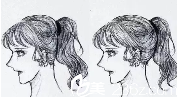 后脑勺整形漫画图