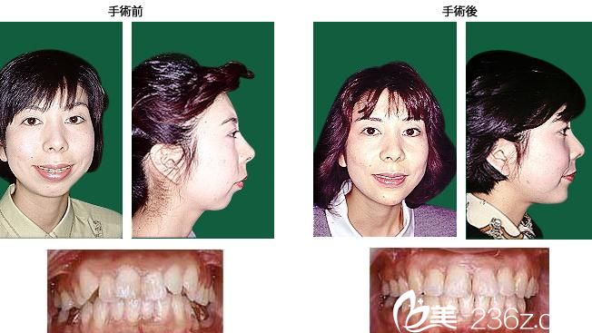 鹤木隆上颚前凸+反对咬合