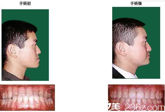 鹤木隆下颚前凸+反对咬合