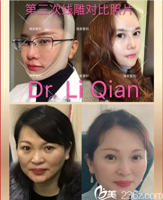 德美360° 网雕逆龄术真人案例对比 德美360° 网雕逆龄术真人案例对比