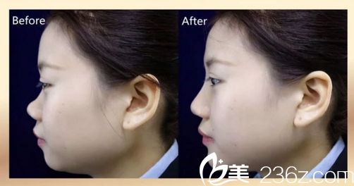 娄底德美玻尿酸注射隆鼻案例对比图 娄底德美玻尿酸注射隆鼻案例对比图