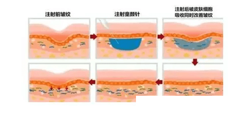  第2阶段 （胶原蛋白形成阶段）