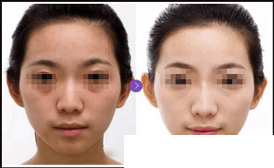 童颜水凝效果案例展示