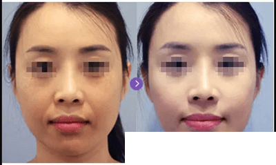 童颜水凝效果案例展示