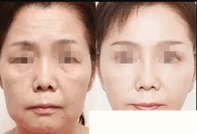 童颜水凝效果案例展示