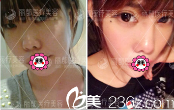 北京米兰柏羽丽都曹卫华双眼皮实例