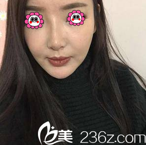 在北京雅靓做面部吸脂第23天效果 在北京雅靓做面部吸脂第23天效果