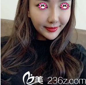 北京雅靓面部吸脂案例 北京雅靓面部吸脂案例